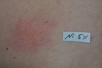 Hautausschlag nach dem Allergietest auf dem Rücken
