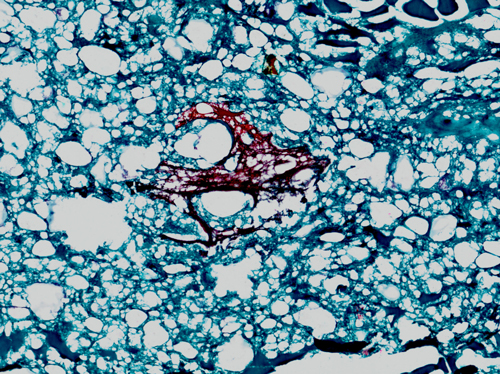 Das Bild zeigt die fotografische Aufnahme eines Mikroskopbildes in 20-facher Vergrößerung. Es handelt sich um einen histologischen Schnitt von einer Brühwurst (Regensburger), die einen Partikel von einer wieder verarbeiteten Brühwurst enthält. Das Brät der Regensburger wird im histologischen Schnitt in türkisblauer Farbe dargestellt und weist eine schwammartige Struktur mit zahlreichen, unterschiedlich großen Hohlräumen auf, wobei es sich um ein Proteingerüst aus koaguliertem Muskeleiweiß und darin enthaltenen, winzigen Luftbläschen handelt. Das Brät der wieder verarbeiteten Brühwurst hat ebenfalls eine schwammige Struktur, färbt sich jedoch rot an. Durch das spezielle Färbeverfahren werden Rauchkondensate enthaltende Teile einer wieder verarbeiteten Brühwurst (Wursthülle und direkt darunter liegendes Wurstbrät) rot gefärbt. Der histologische Schnitt wurde mittels eines Gefriermikrotoms (Schneidegerät zur Herstellung hauchdünner Flächenschnitte) von einem Stück Brühwurst abgeschnitten, auf ein Objektträgerglas aufgezogen, fixiert und mit einem speziellen Färbeverfahren nach Charvát gefärbt. Ein üblicher Schnitt in der Lebensmittelhistologie hat ungefähr eine Fläche von 2 x 2 cm und eine Dicke von etwa 10 &mu;m (ca. 1 hundertstel mm).