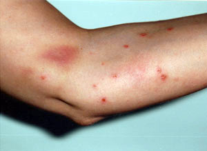 Hautausschlag auf einem Arm