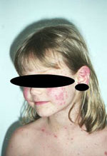 Hautausschlag im Gesicht eines Mädchens