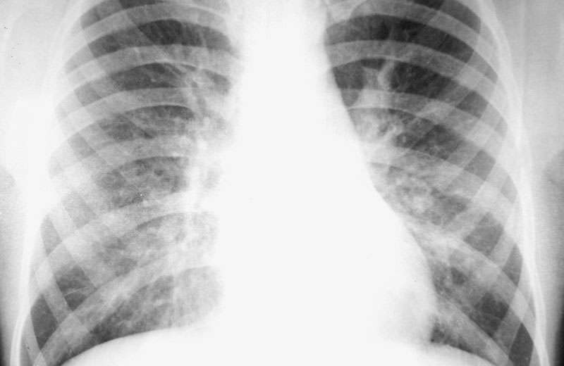 Röntgenbild einer Lunge.