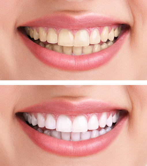 Gegenüberstellung zweier Bilder: Foto 1: Mund mit gelblich verfärbten Zahnen, Foto 2: Mund mit weißen Zähnen 