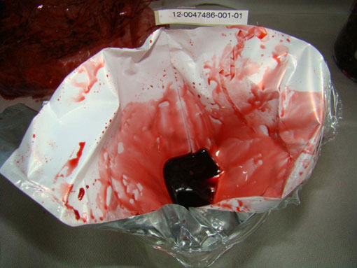 rot gefärbe Flüssigkeit in Plastikbeutel